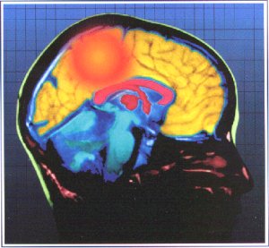 graphic of brain for article entitled 